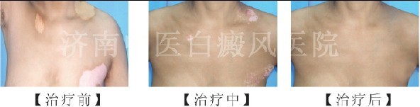 白斑